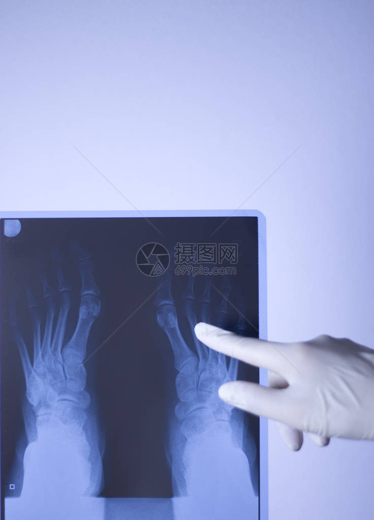 医院X射线足部创伤学扫描图片