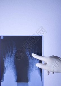 医院X射线足部创伤学扫描图片