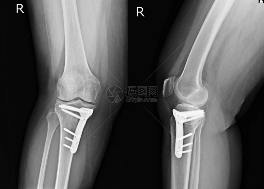 X射X光Knee显示右膝下部手术图片