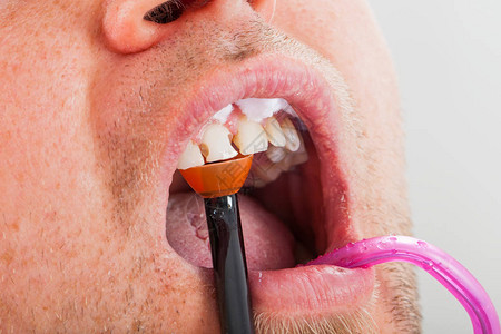 口腔内用聚合灯进行牙科治疗图片