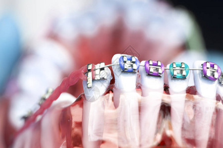 牙科金属牙套齿保持器对准器教学正畸模型图片