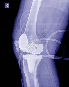 X射线图像术后全膝关节置换右膝图片
