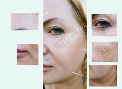 女人在手术前后脸上的皱纹色素沉着图片