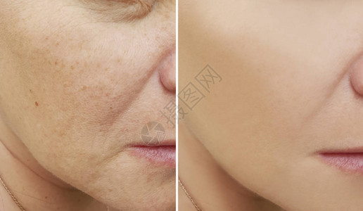 皱纹脸女人手术前后图片