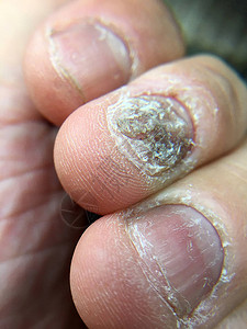 指甲手真菌感染的大特写高清图片