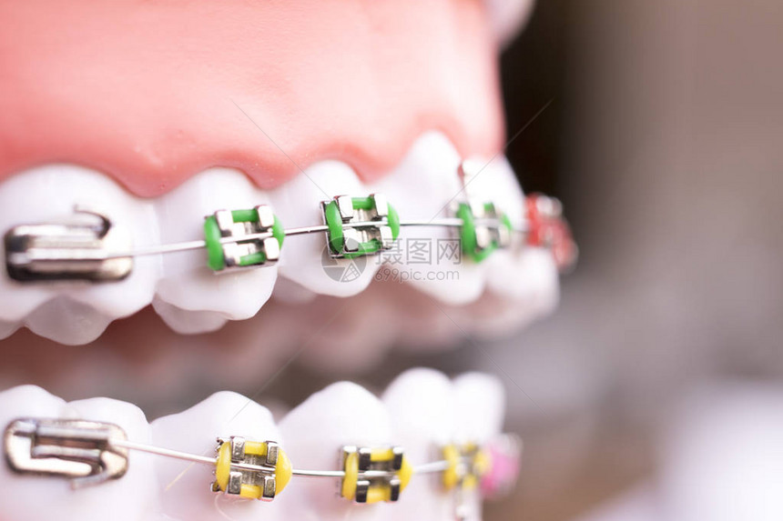 牙科金属牙套齿保持器对准器教学正畸模型图片