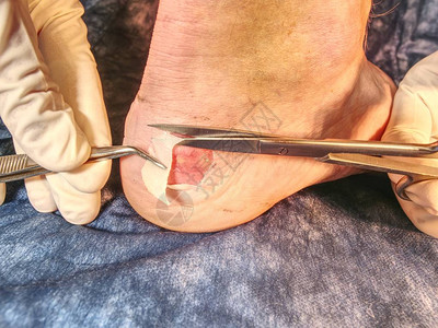 外科医生用无菌剪刀割伤病人的死皮图片