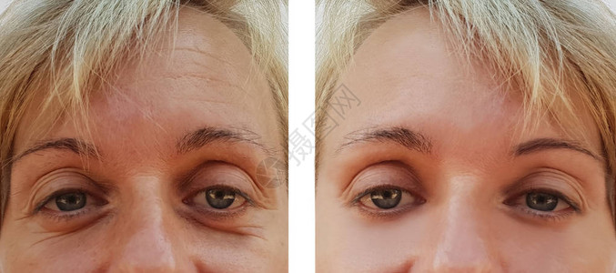 在抗老年手术前后妇女脸上的图片
