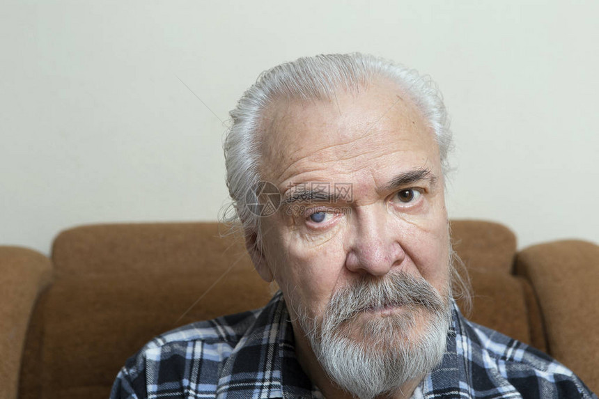 一位老人患有白内障和青光图片