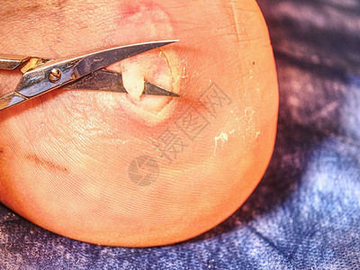 外科医生用无菌剪刀割伤病人的死皮图片