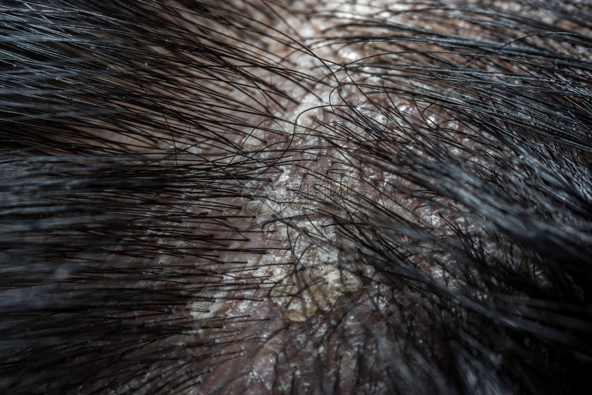黑头发的人类有问题因为荷尔蒙脏乱和压力等原因皮肤病导致淋巴虫图片