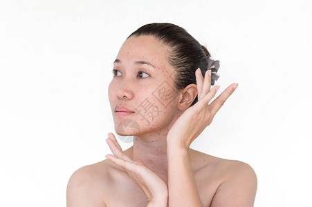 亚洲妇女脸部和颈部的烧焦点或激光处理皮雀斑图片
