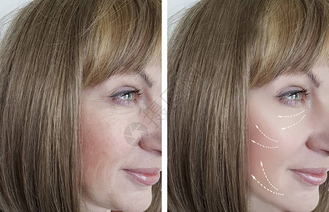 女人在手术前后的皱纹面部图片