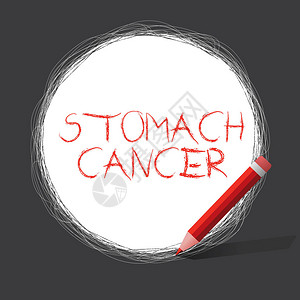 商业照片展示了胃部的恶肿瘤从内衬开始出现在腹部和胃部之间有图片