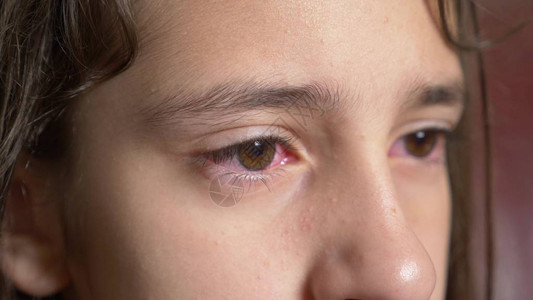 小女孩用结膜炎显示眼睛病图片