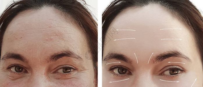 面部女手术前后脸上的皱纹箭头图片