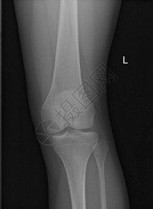 X射X光人体膝盖放射线图片