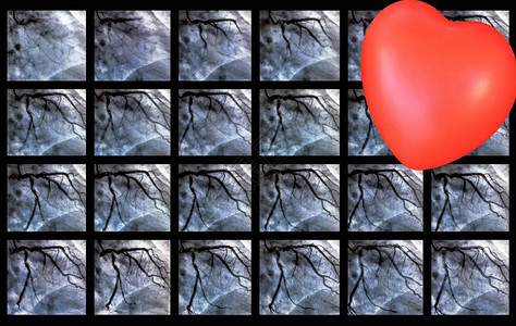 心导管术中左冠状动脉的冠状动脉造影导尿心室造影是用于确定患者心脏功能的背景图片