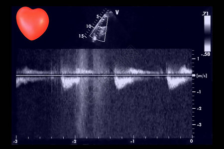 超声波图像和小心脏回声心动机屏幕图片