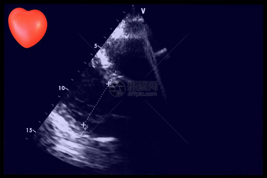 超声波图像和小心脏回声心动机屏幕图片