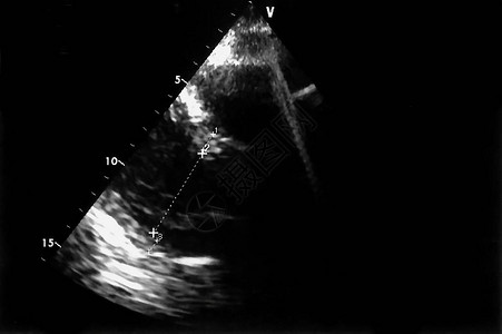 超声波图像回声心动机屏幕图片