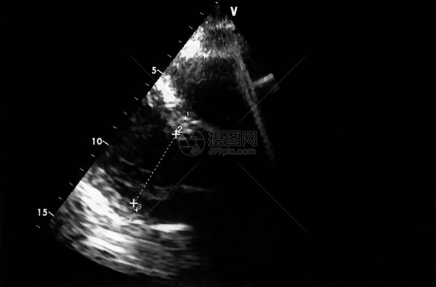 超声波图像回声心动机屏幕图片
