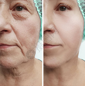 手术前后老妇人脸上的皱纹背景图片