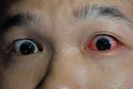 眼睛发红和发炎结膜炎图片