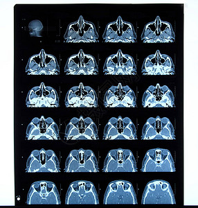 头部X光片切片CT图片