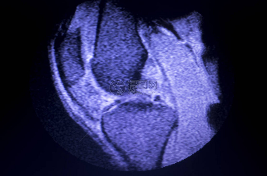 磁共振成像MRI膝盖后部角中枢断裂的眼泪图片