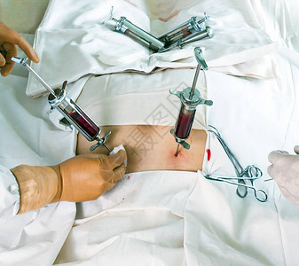 骨髓移植手术背景
