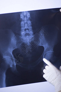 医院X射线腰痛脊柱和臀部创伤学扫描图片