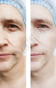 皱纹脸上的人在治疗前后图片