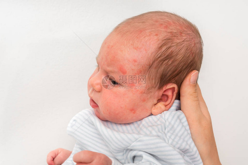 新生婴儿皮肤疹出生后过敏反应身体图片