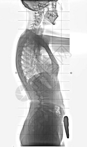 人体从胸部到骨盆完整的脊椎基磷和发病的图片