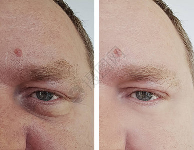 手术前后男眼部皱纹图片