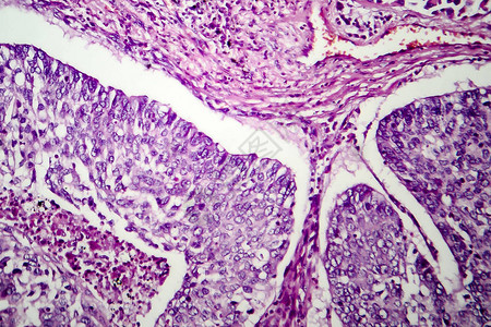 肺腺癌光学显微照片显微镜下的照片图片