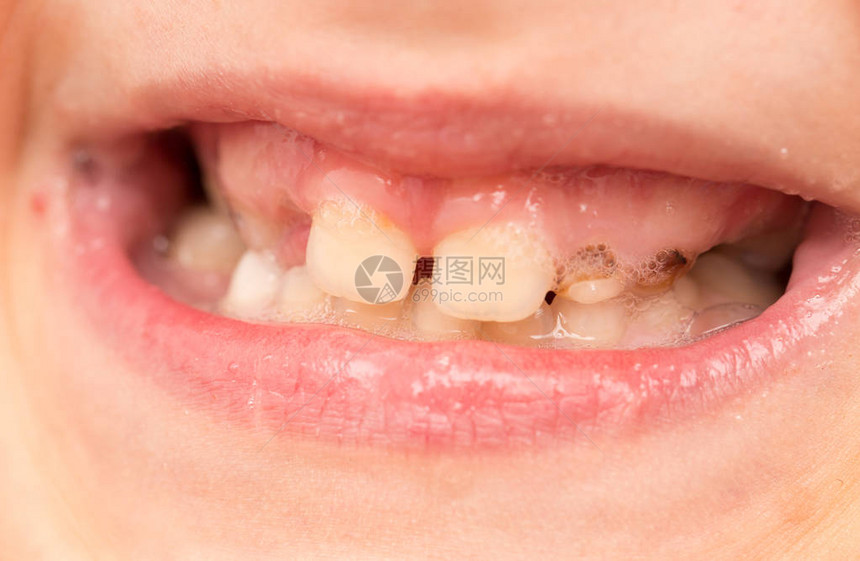 口腔中婴儿的牙齿工图片
