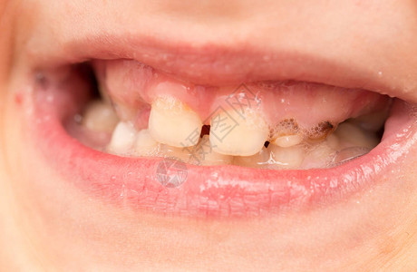 口腔中婴儿的牙齿工图片
