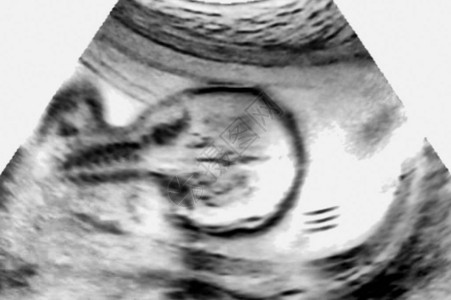 Embryo超声波后视图片