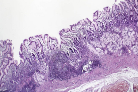 慢浅表胃炎的组织病理学背景图片