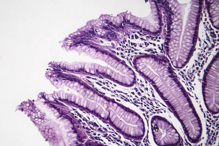 慢浅表胃炎的组织病理学图片