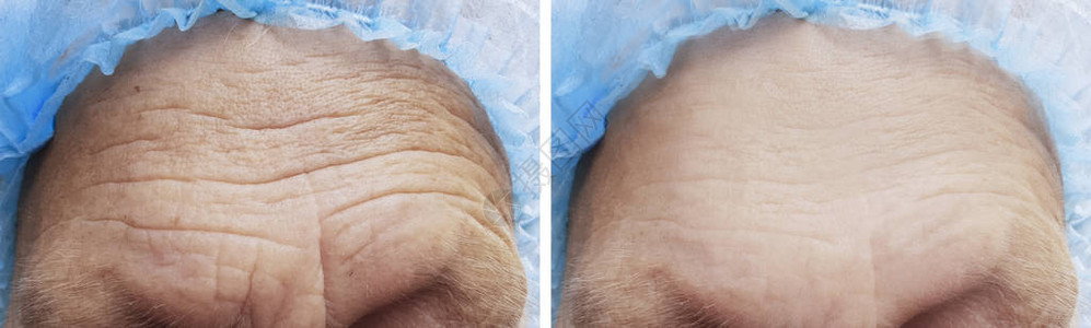 前额皱纹在手术前后图片