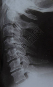 男子颈部的X光片背景图片