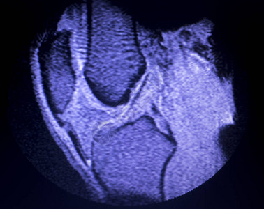 磁共振成像MRI膝盖后部角中枢断裂的眼泪图片