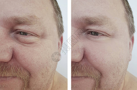 手术前后男眼睛肿胀皱纹图片