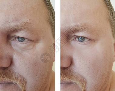 在手术前后雄眼皱纹在手术前图片