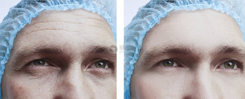 治疗前后男眼部皱纹图片