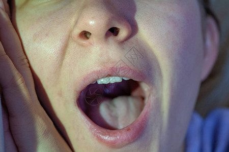 口腔内喉咙痛特写视图体检咽和扁桃体喉咙里有红色水泡喉咙舌图片
