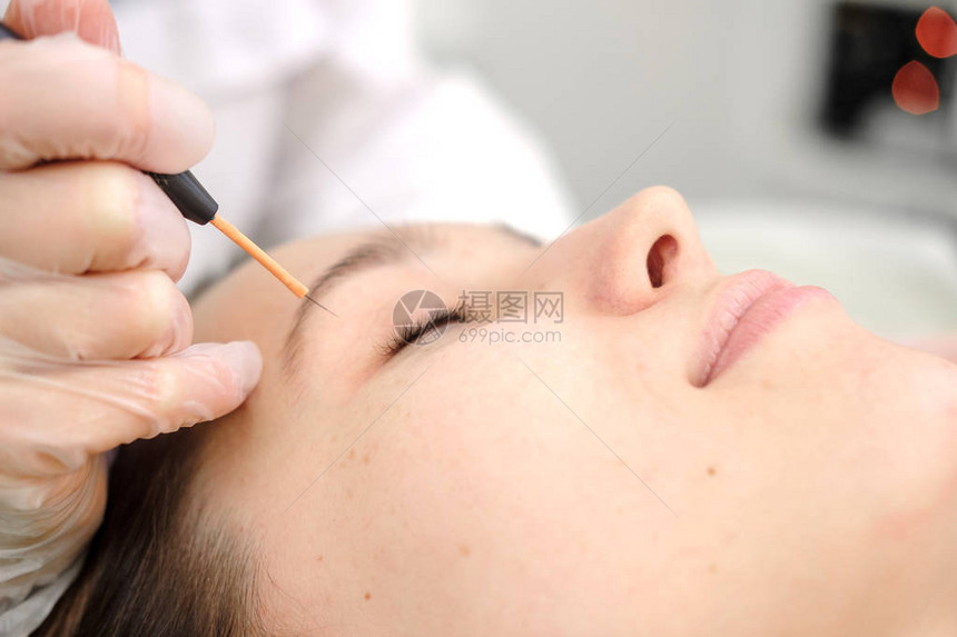 从女患者的脸上去除胎记的医学治疗使用电烙器去除痣的女皮肤科医生无线电波凝图片